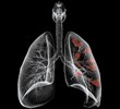 New lung cancer diagnostics developed in Kazan