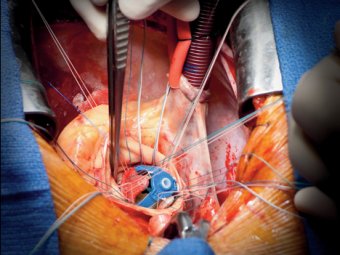 Человек смоделировал имплантат для собственного сердца